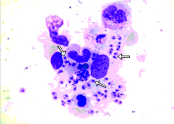 مرض “الليشمانيا”